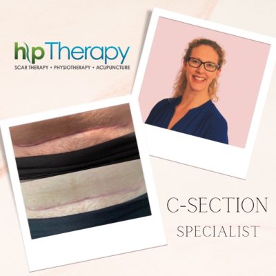 The best C-section recovery kit - HLP Therapy 